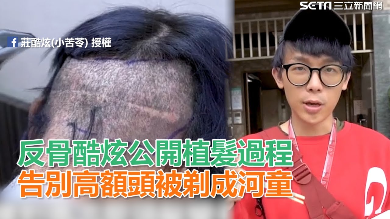 反骨酷炫公開植髮過程　為告別高額頭被剃成河童｜三立新聞網SETN.com