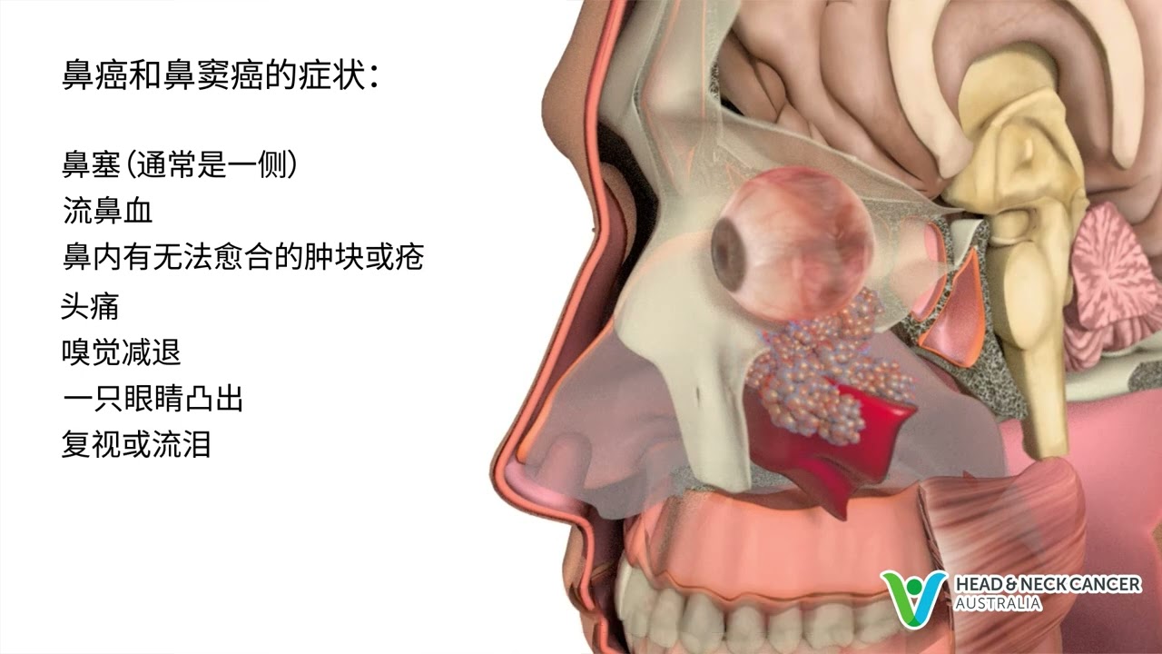 Mandarin/ Simplified Chinese - What is Sinus Cancer / Nasal Cancer? Signs & Symptoms.