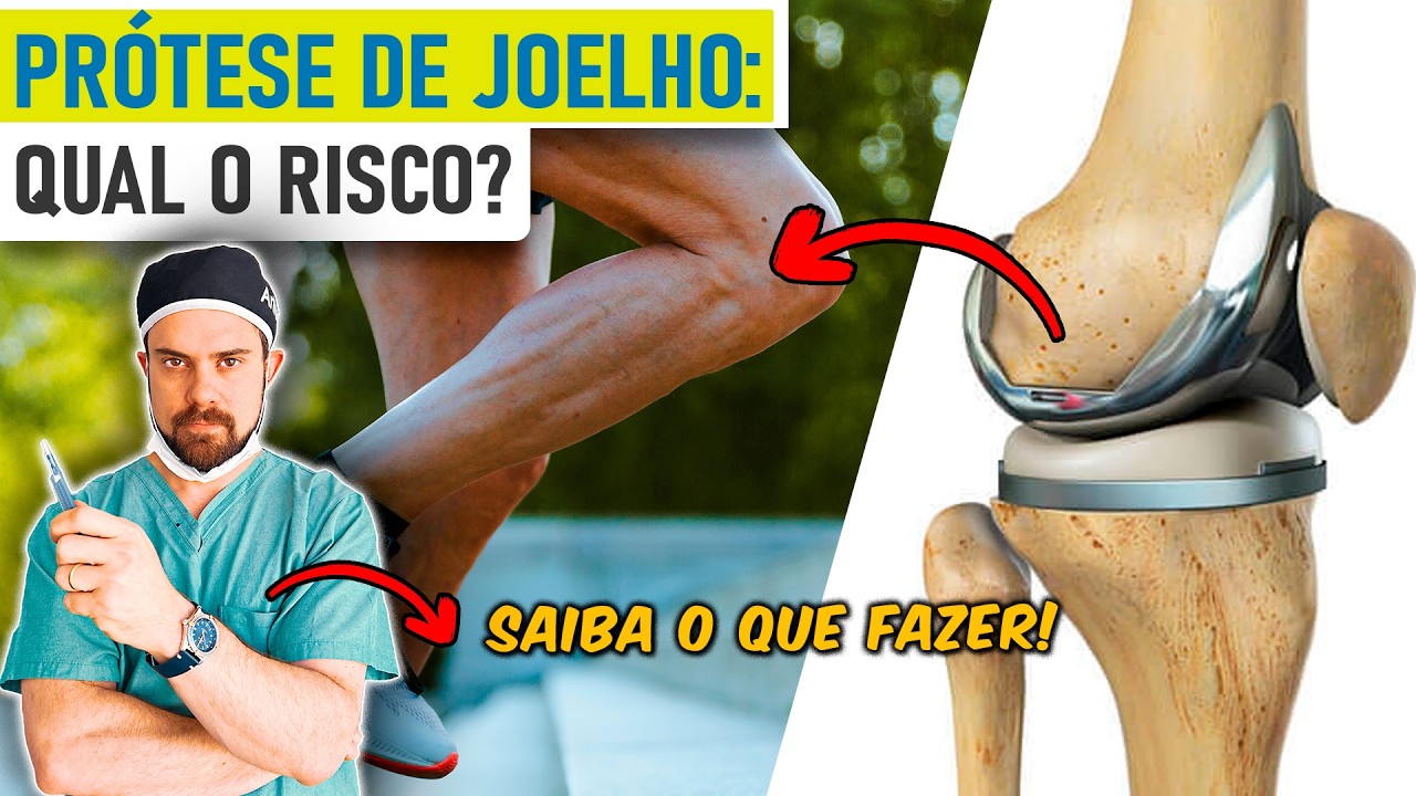 Prótese de Joelho: as 12 Principais Complicações, Como Prevenir e Tratá-las? [Aulão c/ Ortopedista]