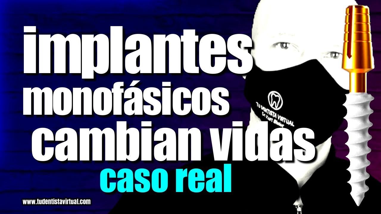 PACIENTE CUENTA su EXPERIENCIA con los NUEVOS IMPLANTES que NO NECESITAN INJERTOS de HUESO.