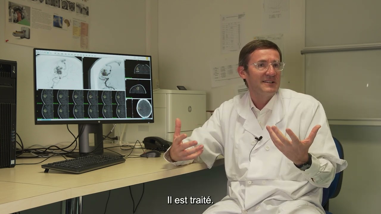 Comment se passe une séance de radiochirurgie pour une MAV cérébrale ?