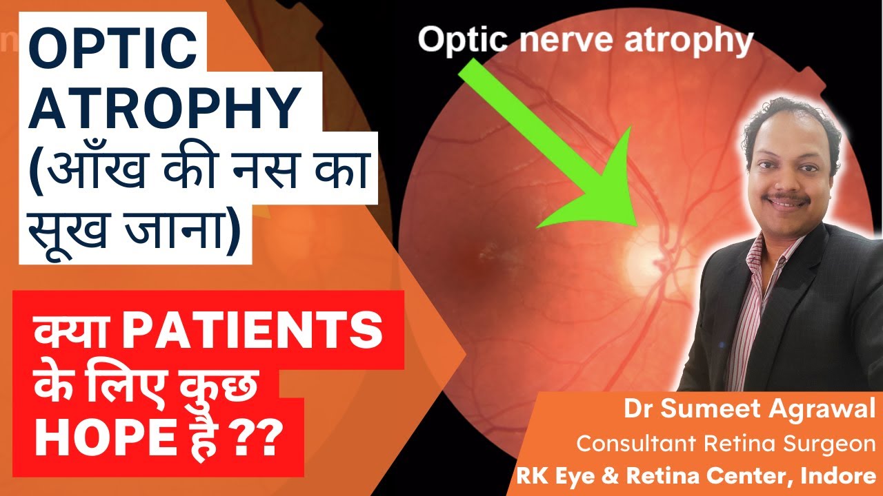 OPTIC ATROPHY : आँख की नस का सूख जाना ! क्या हमेशा के लिए रोशनी हो जाएगी ख़तम ?