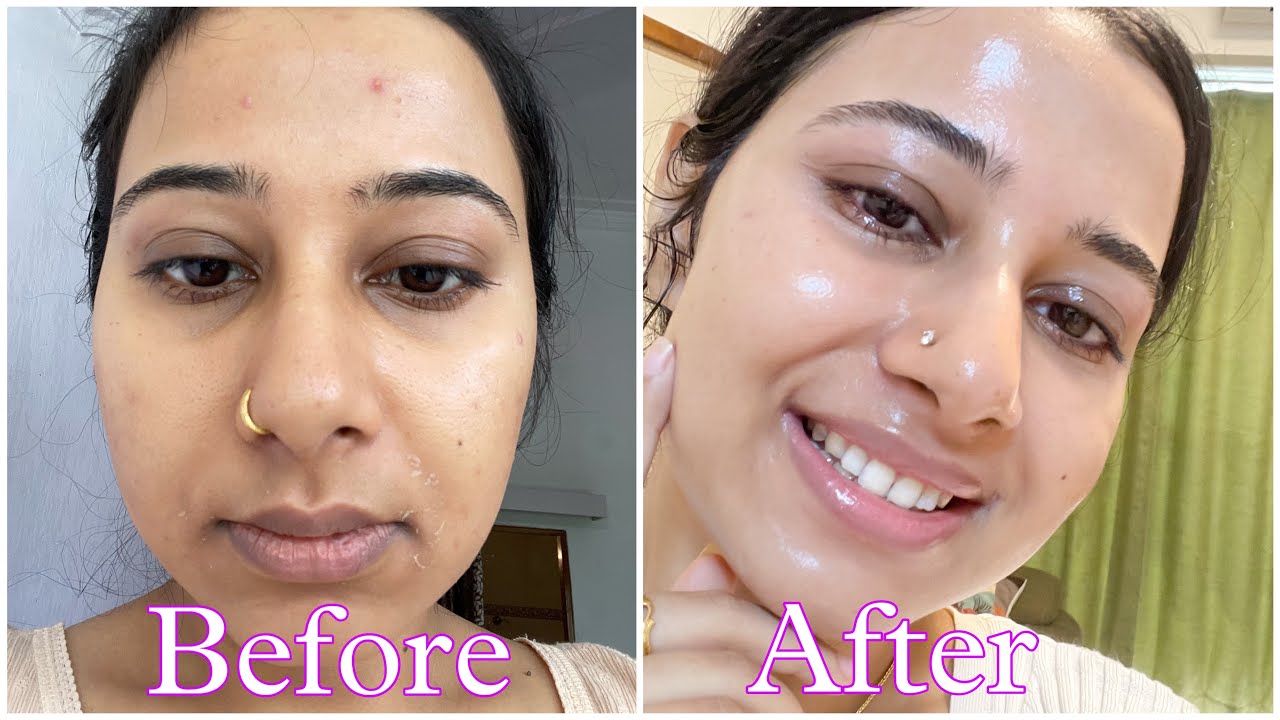 Dermatologist recommended Best 2 Cream under Rs 300 that has changed my skin | Best pharmacy cream
