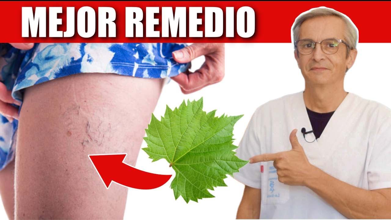 MEJOR REMEDIO para las VARICES [insuficiencia venosa]