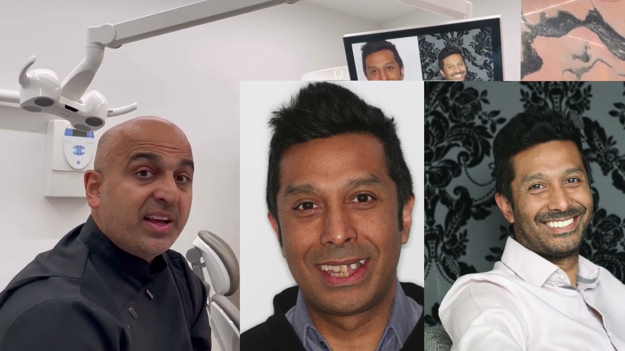 All-on-6 Dental Implants after an Aggressive Gum Disease. Striking life-changing transformation