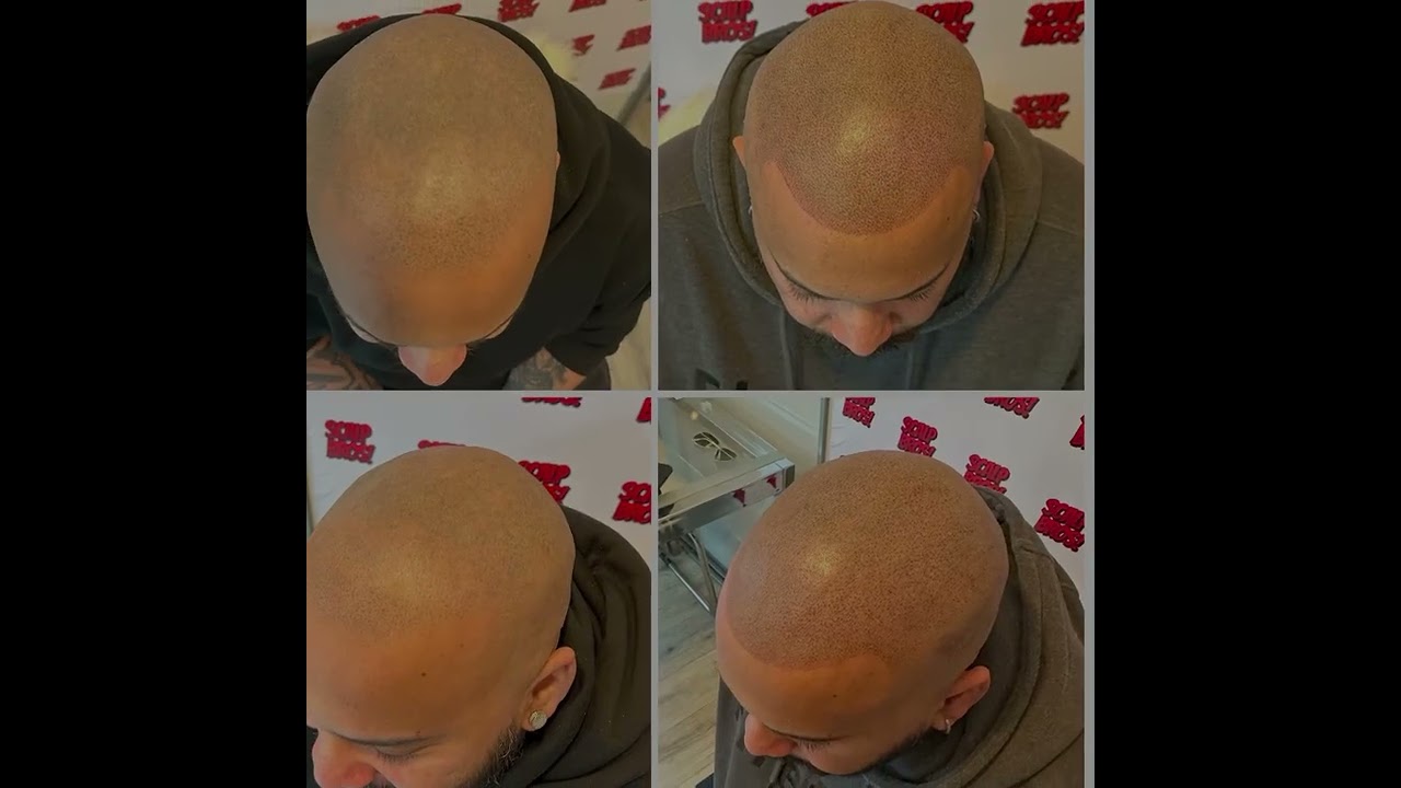 Scalps Bros Edinburgh helping clients regain their confidence with scalp Micropigmentation. #smp