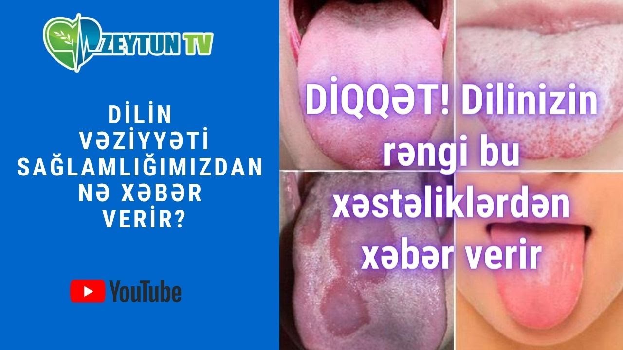 DİQQƏT! Dilinizin rəngi bu xəstəliklərdən xəbər verir