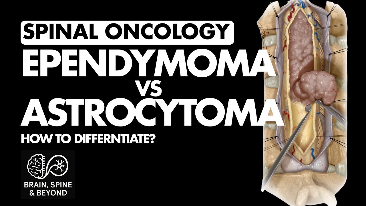 How to Differentiate Intramedullary Spinal Tumours? How to Interpret the MRI?