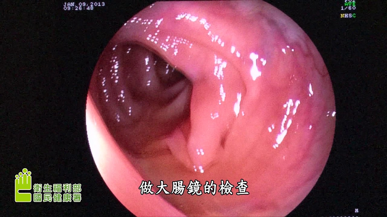 51164_大腸癌：我應該做哪些篩檢檢查？(國語版)