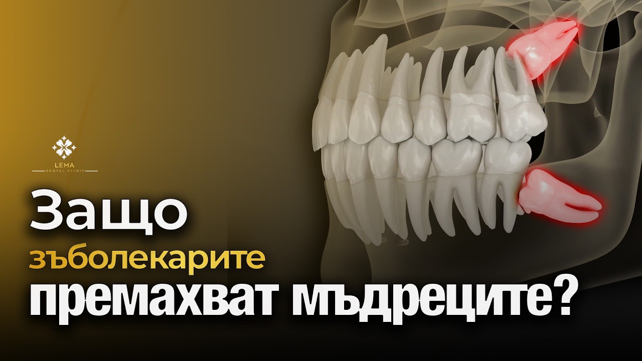 🤍 Почему стоматологи рекомендуют удалять зубы мудрости? - Стоматологическая клиника Lema