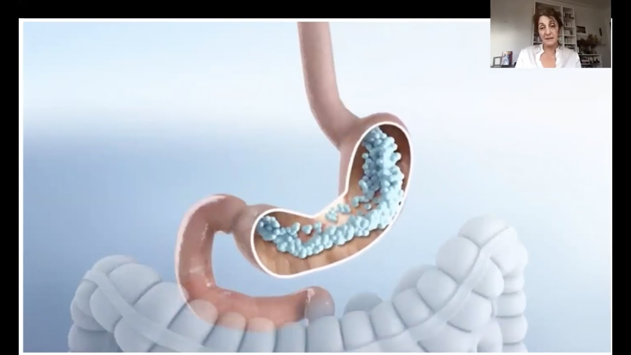 Sleeve endoscopique, ballon gastrique : comment ça marche ?