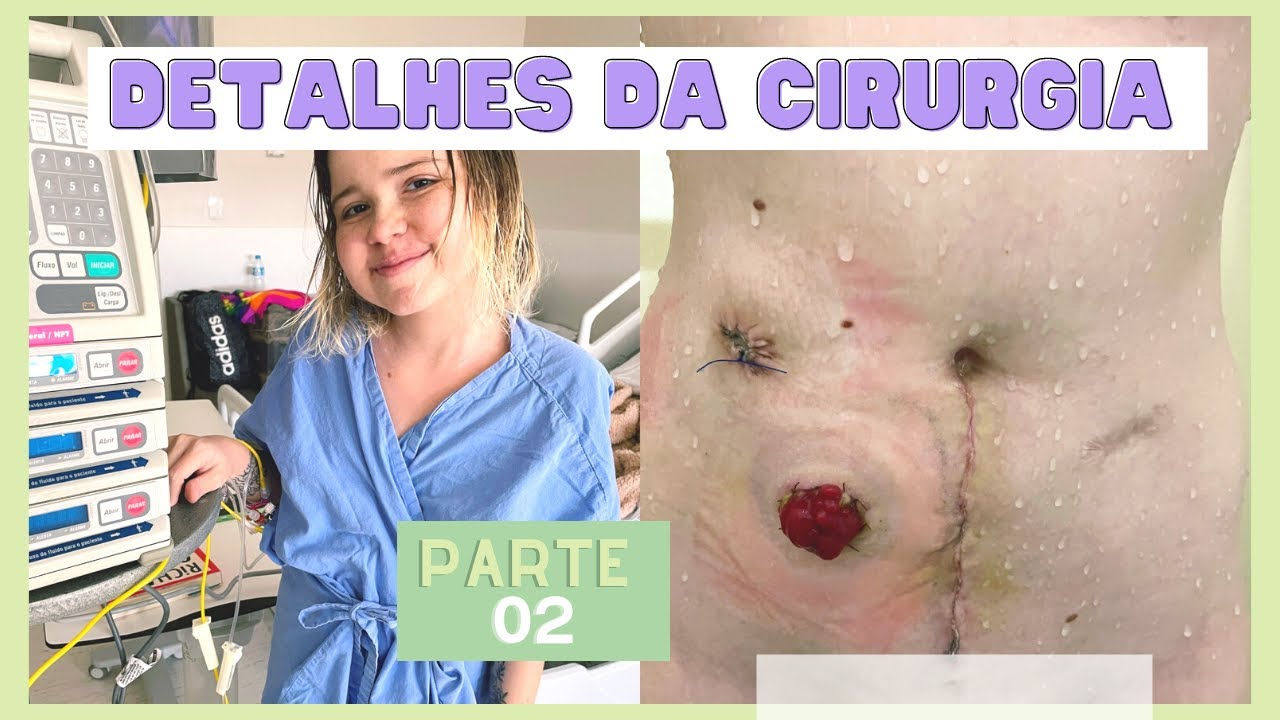 RETIREI 1 METRO DE INTESTINO - MINHA CIRURGIA parte 02