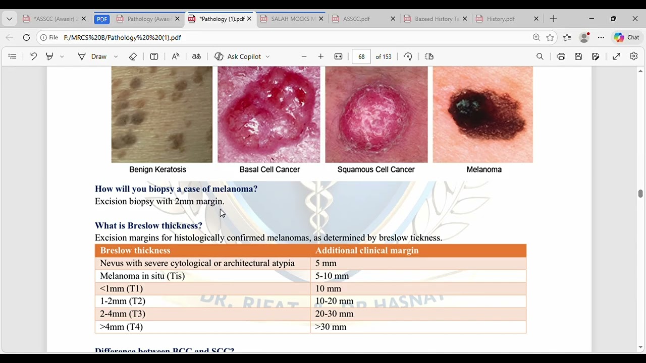 Malignant Melanoma for MRCS B#mrcsbites #pathology #mrcspartb #mrcspreparation