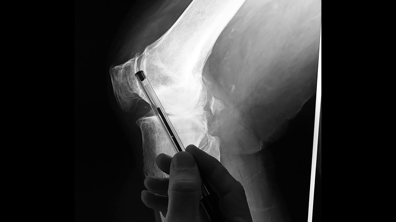 Artrosi: Come leggere una Rx (radiografia).