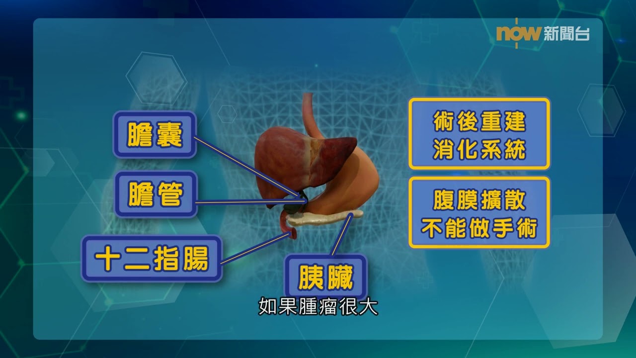 20250416【杏林在線】胰臟癌與糖尿病