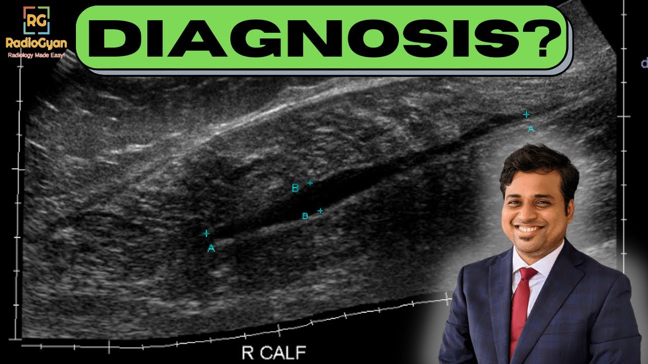 MSK Ultrasound Case Presenting in the ER | Diagnosis?
