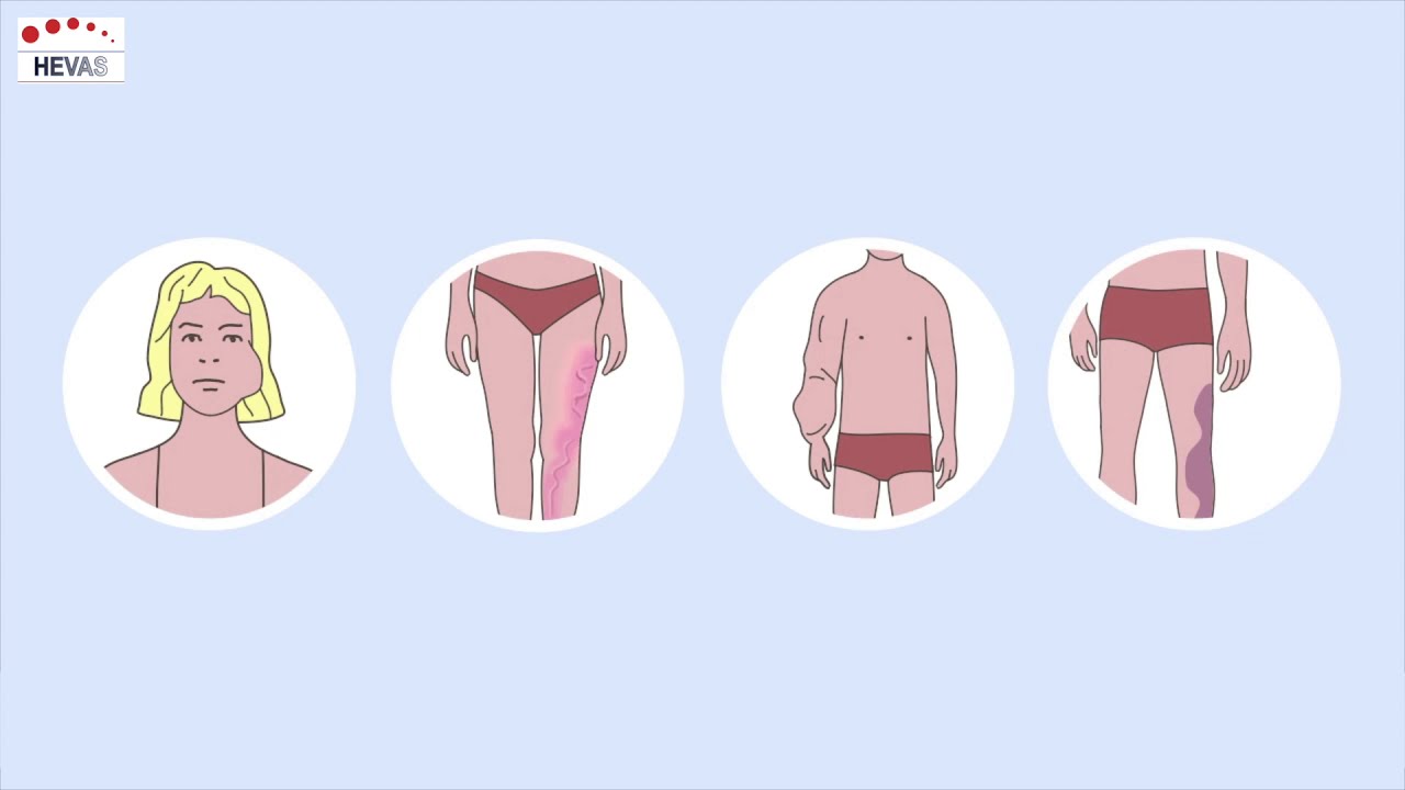 Animation: PIK3ca gene mutation in PROS