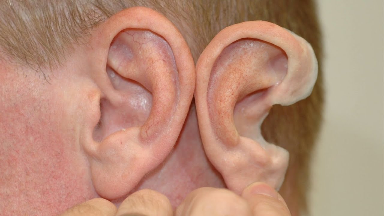 Ear Prosthetics
