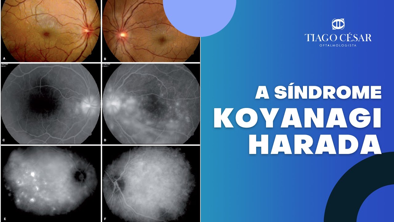 Síndrome de Koyanagi-Harada | Dr. Tiago César - Oftalmologista em Belo Horizonte