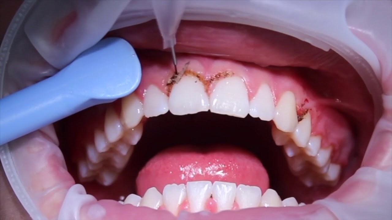 les finitions orthodontiques: la place du laser diode