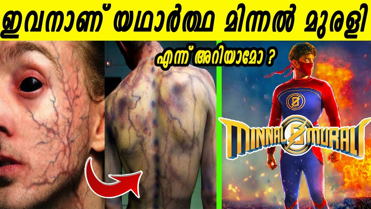 ഒരു അപകടത്തിന് ശേഷം യഥാർത്ഥ സൂപ്പർപവറുകൾ നേടിയ ആളുകൾ|ഒറ്റ സെക്കന്റിൽ കലകളും വിവിധ ഭാഷകളും ലഭിച്ചവർ