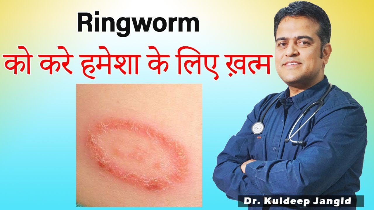 Ringworm Treatment (दाद) | Fungal Infection Infection Best Treatment | Best Homeopathic Doctor