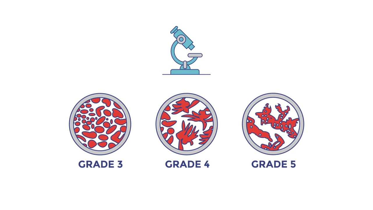 Gleason Grading