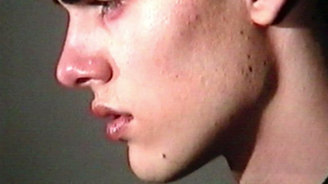chin implant