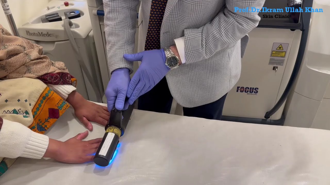 Vitiligo Laser Treatment by Prof.Dr.Ikram Ullah Khan