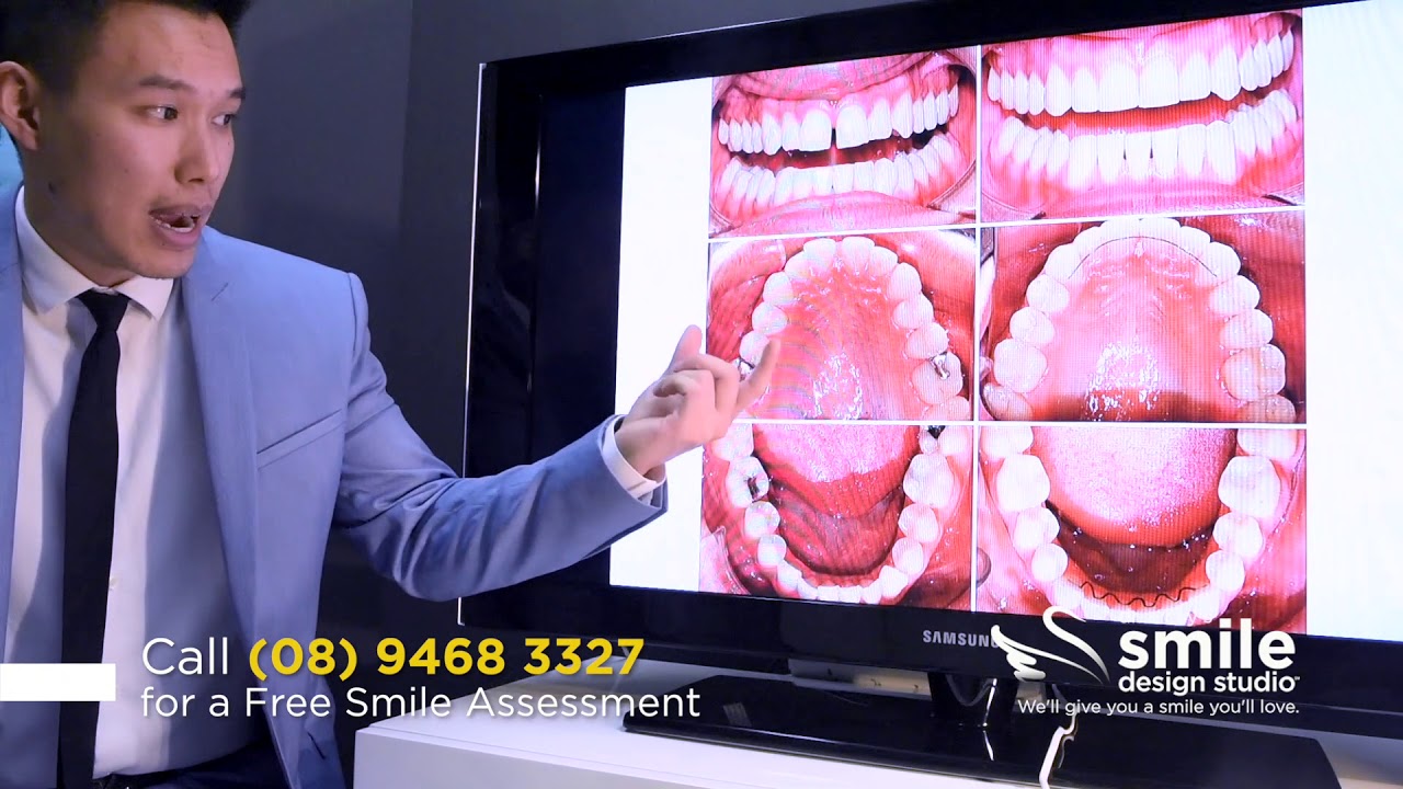 Damon Clear Braces - Treatment for Gaps, Crowding and Narrow Arches