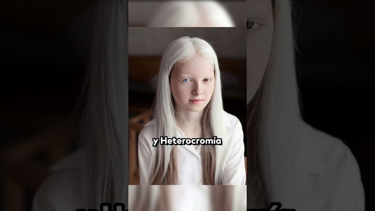 La ni&ntilde;a con Albinismo y Heterocrom&iacute;a #shorts