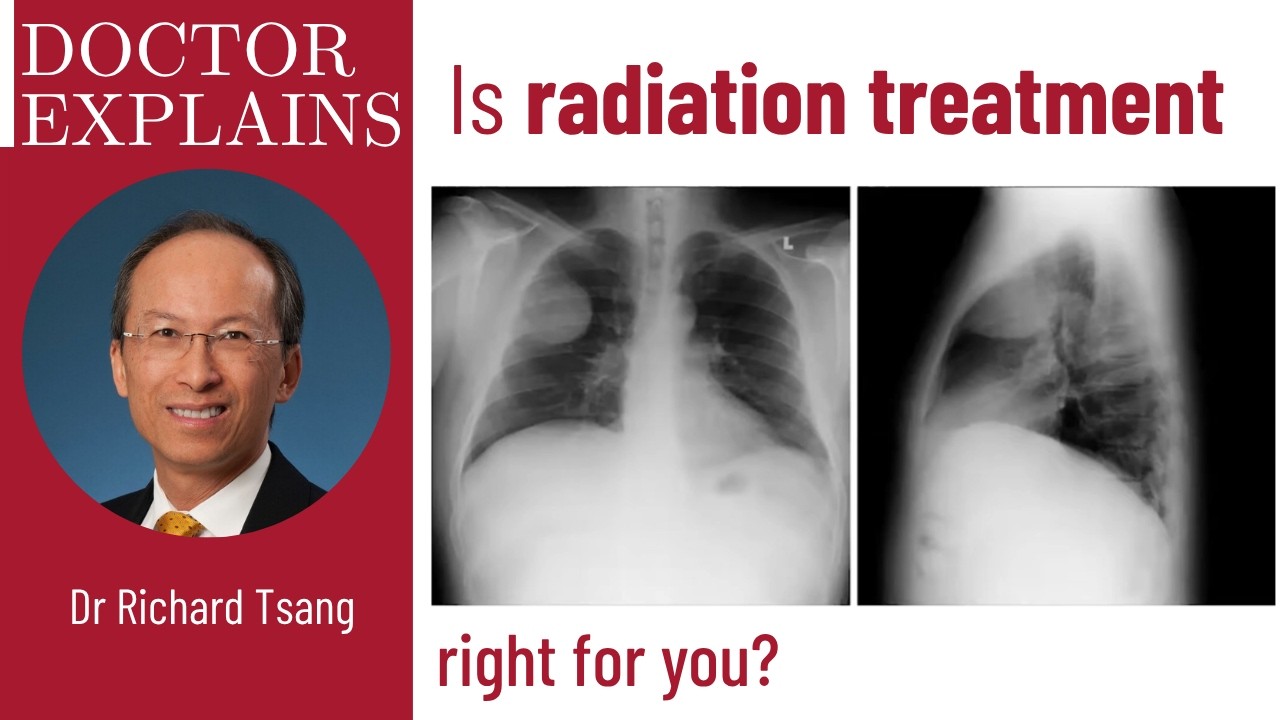 The Use of Radiation Therapy for Multiple Myeloma