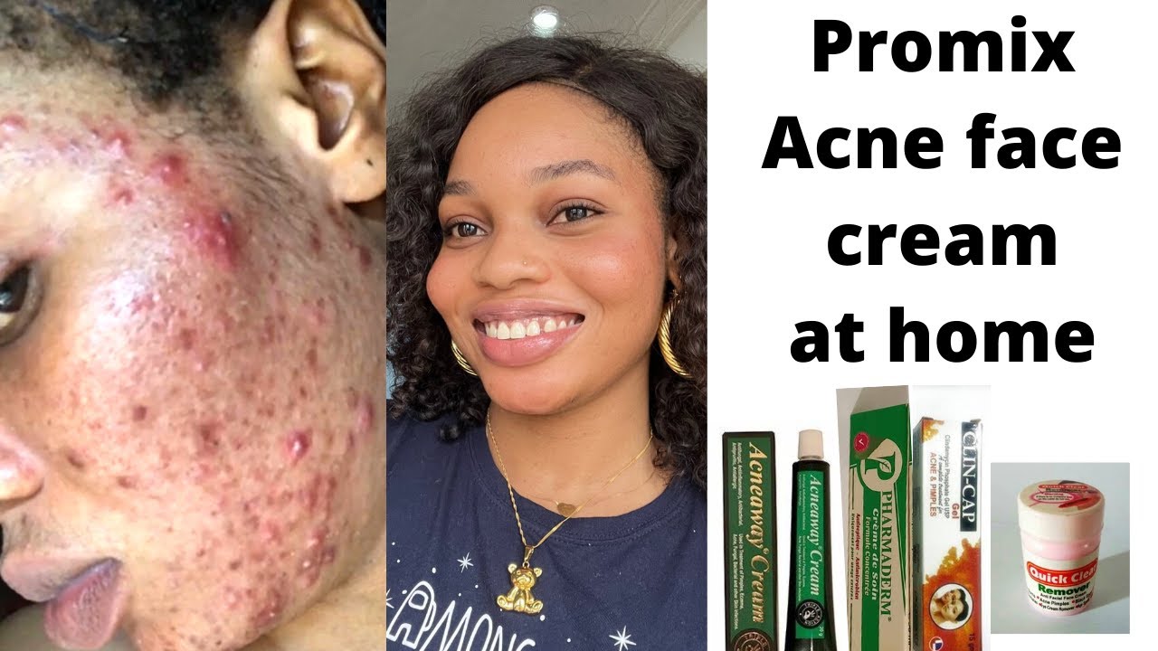 How to make the most effective acne face cream for stubborn acne/acne face cream for all skin types