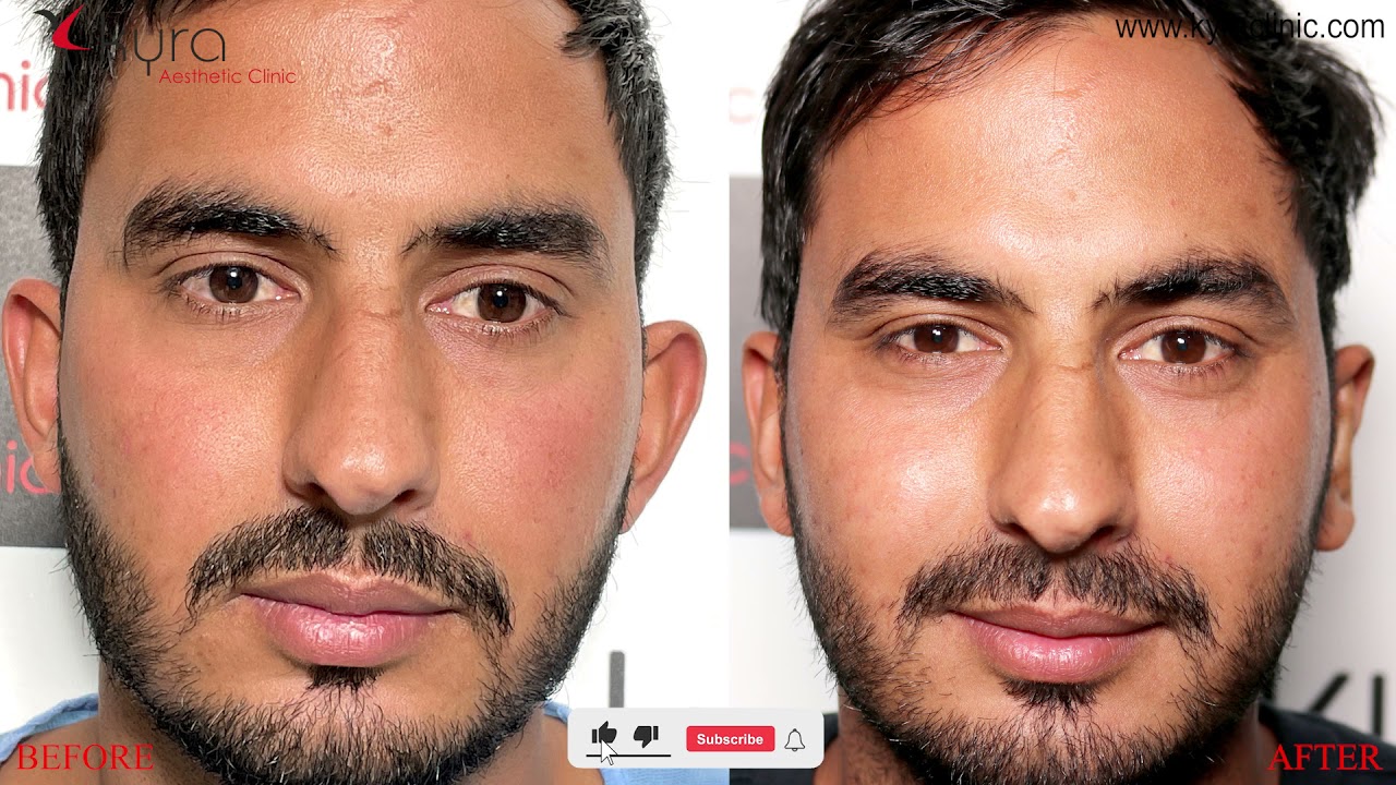 Otoplasty, Otoplasty Recovery, Otoplasty before and after pictures | Dr. Vikas Gawri