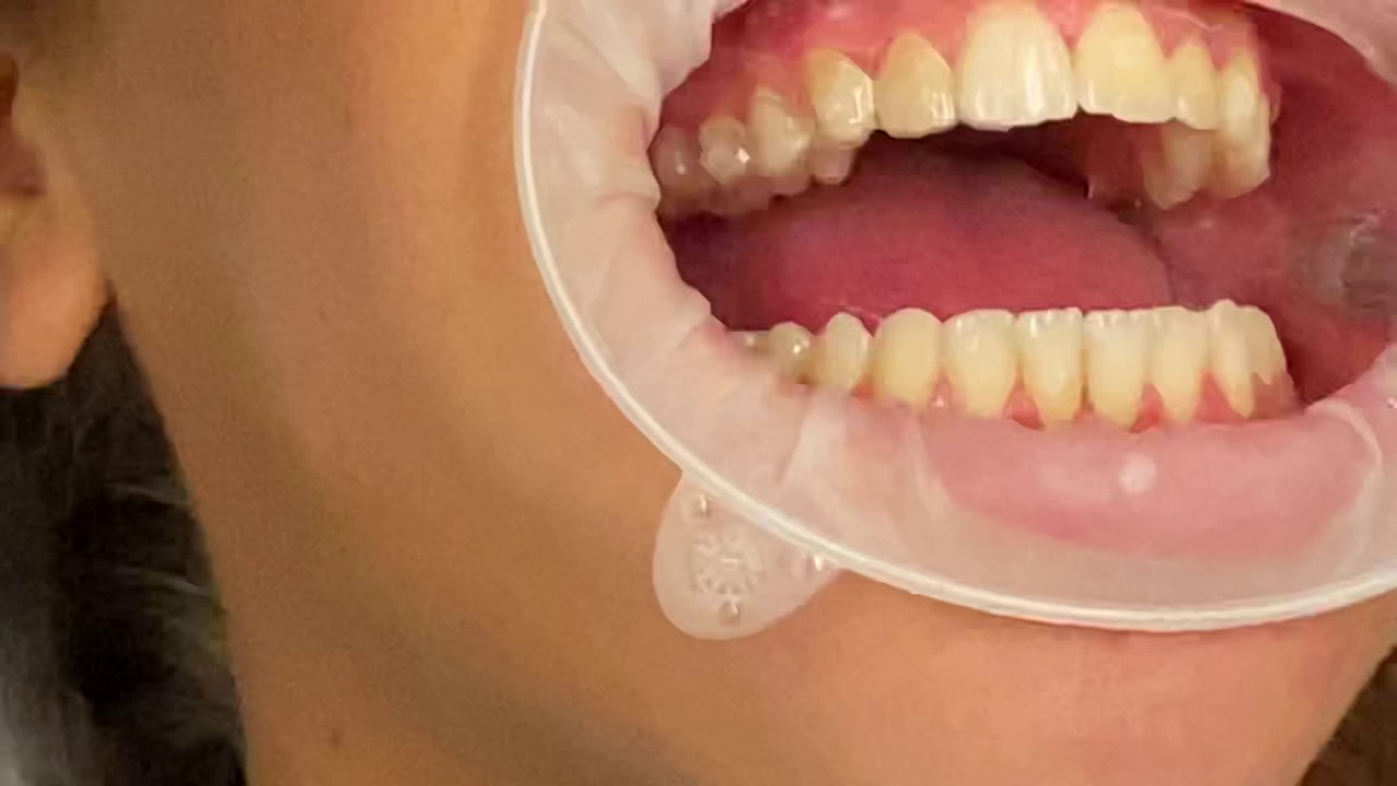 Invisalign Attachments On