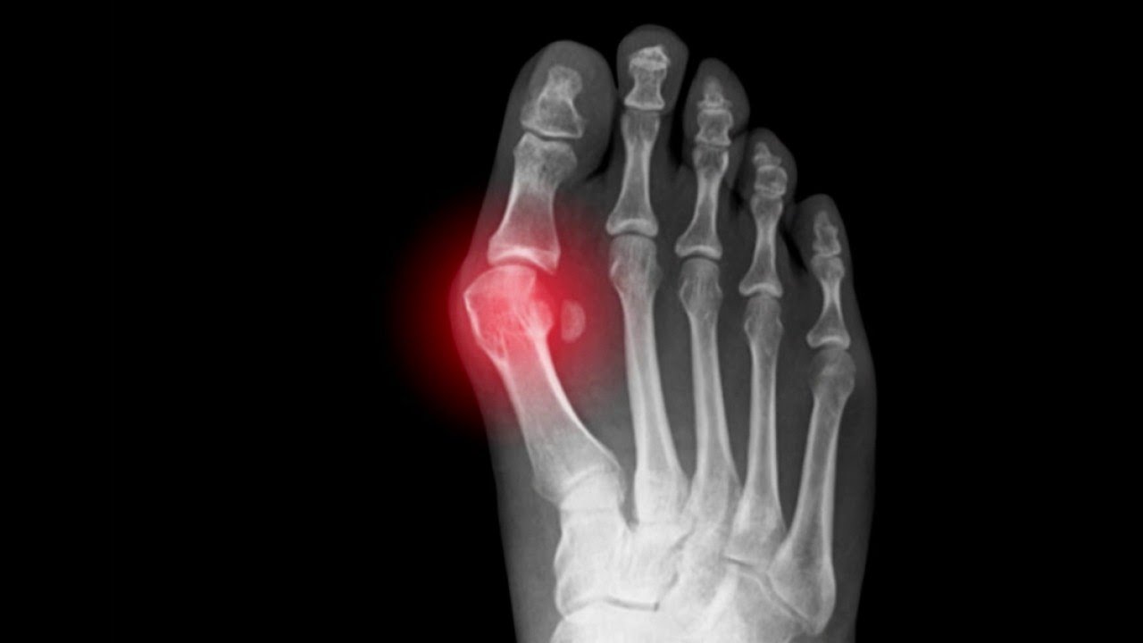 Santé - Hallux valgus : la solution chirurgicale