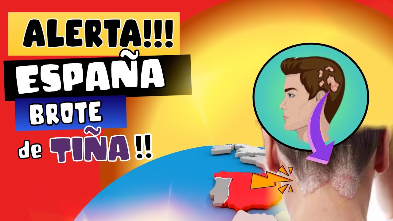 ALERTA ⚠️ DERMAT&Oacute;LOGOS EN ESPA&Ntilde;A ALERTA BROTE DE TI&Ntilde;A CAPITIS &iquest;QU&Eacute; ES?😱