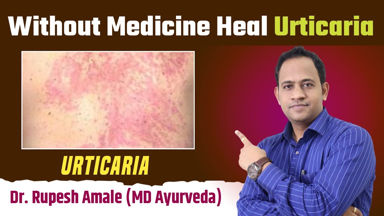 दवा के बिना शीतपित्त को अच्छा करने का सही उपाय l get rid of Urticaria without Medicine by Dr. Amale