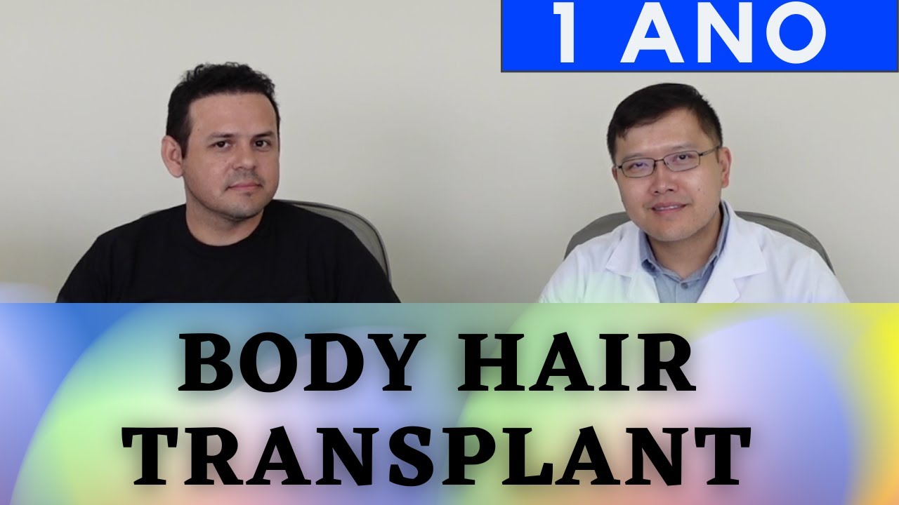 Transplante capilar com pelo corporal realmente vale a pena para aumentar  #resultado ? Dr. Paulo Lu