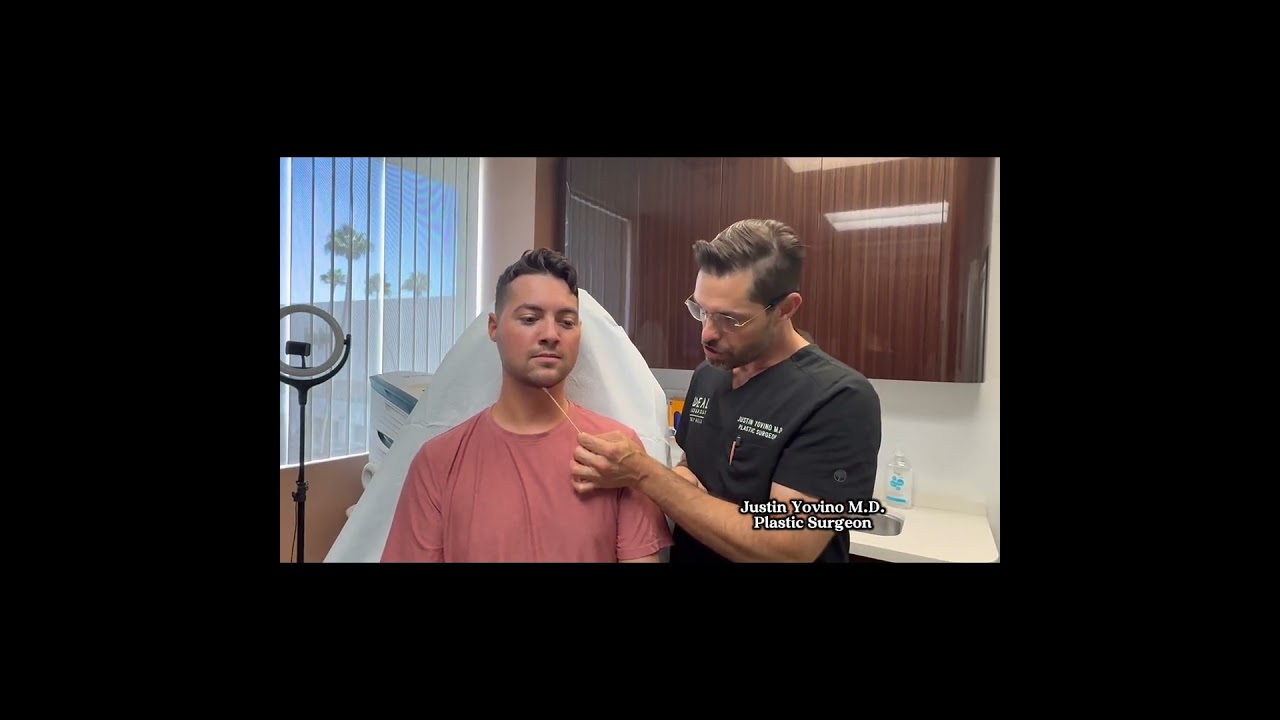Minimally Invasive Neck Lift | Precision Sculpt® Submentoplasty at Ideal Face & Body 