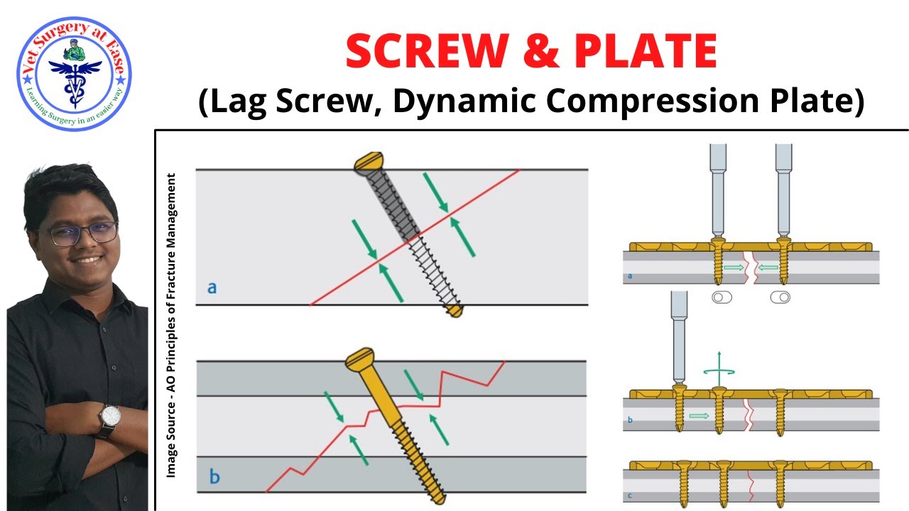 Screw & Plate | Lecture 09 | Orthopedics
