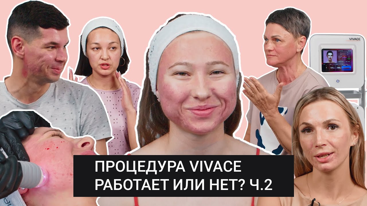 Процедура микроигольчатого rf-лифтинга VIVACE: работает или нет? Реальные отзывы 5 пациентов