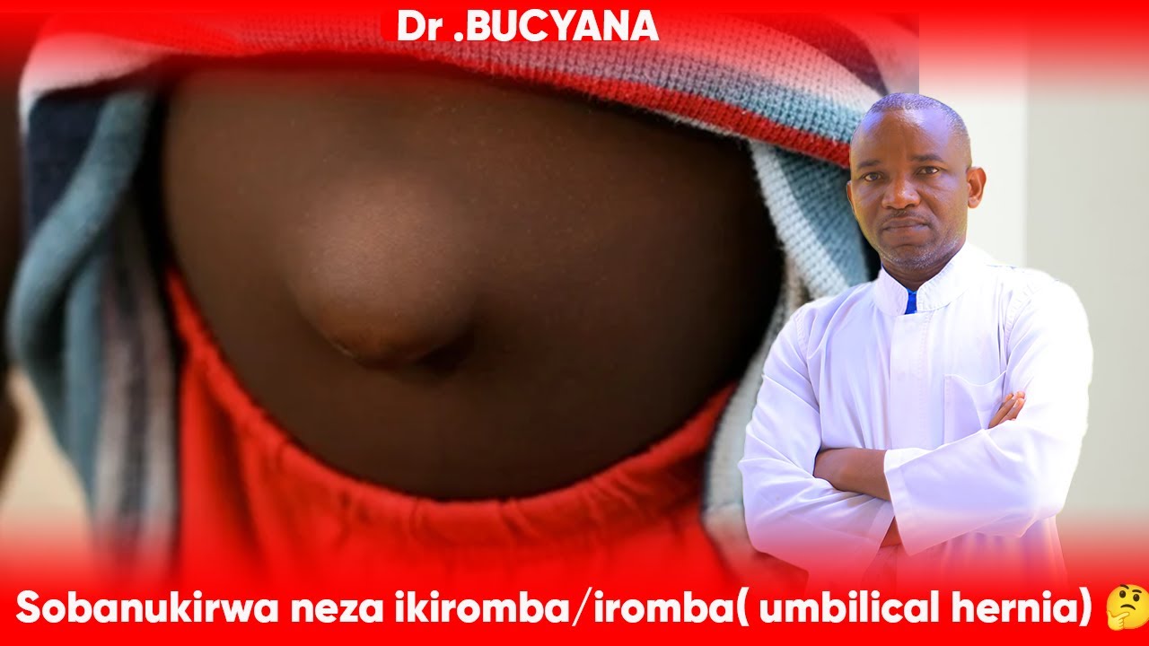 Dr BUCYANA:  SOBANUKIRWA IKIROMBA/IROMBA (Umbilical hernia), ESE NI UBURWAYI?
