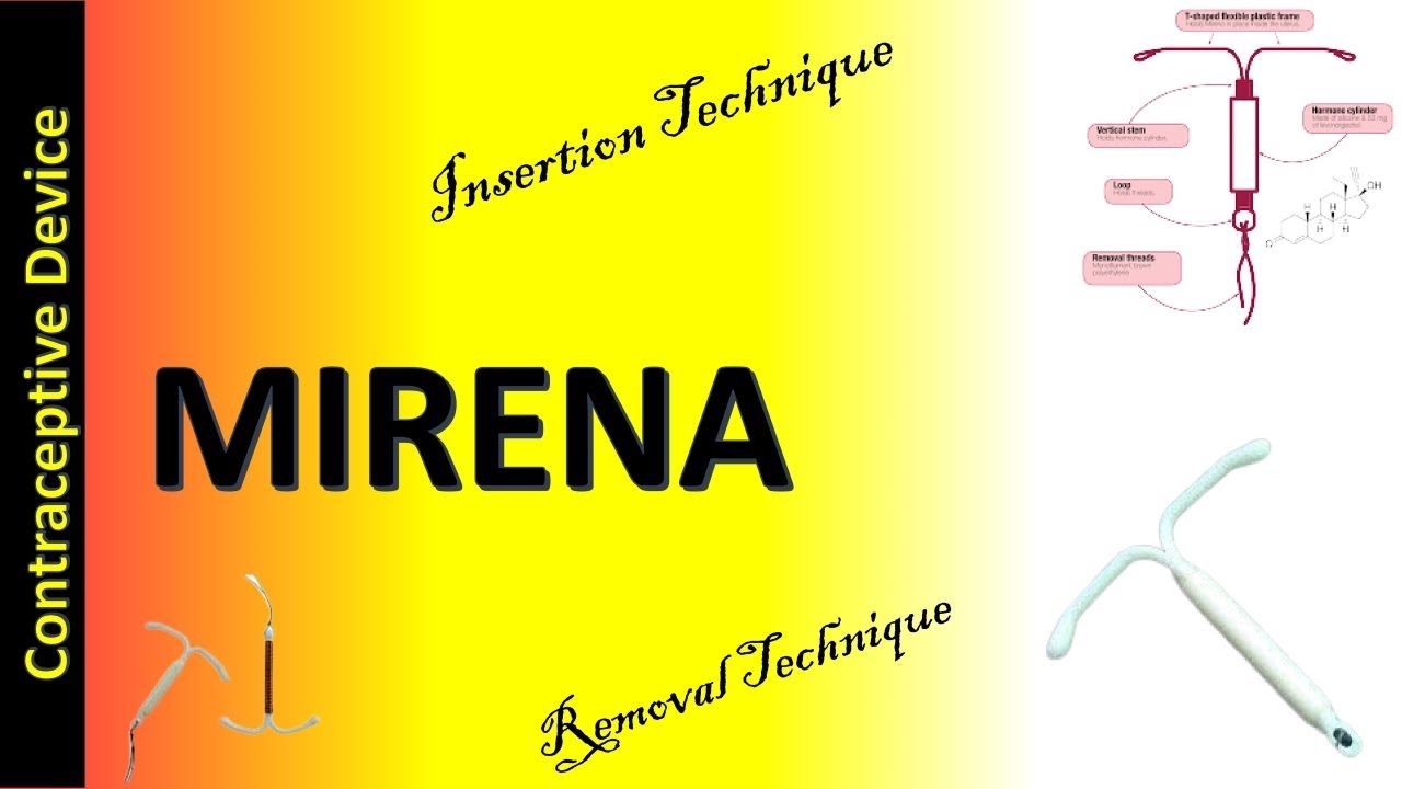 Mirena |  Levonorgestrel Releasing Intrauterine System | Mirena Insertion and Removal Technique