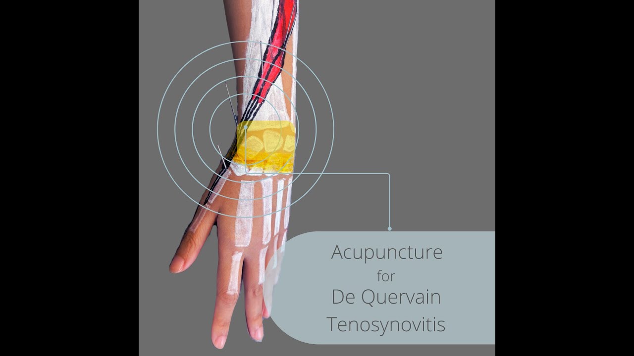 ✨Acupuncture for De Quervain’s Tenosynovitis✨ (ENG)