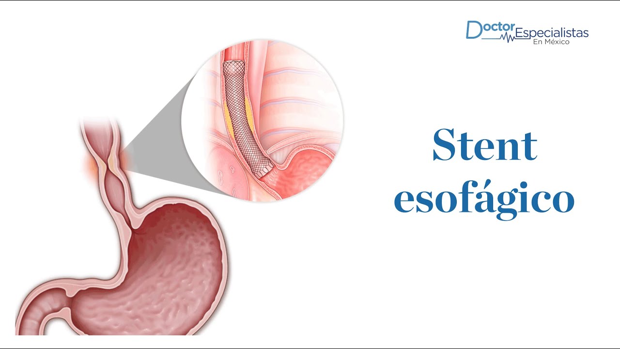 Stent esof&aacute;gico - Doctor Especialistas M&eacute;xico