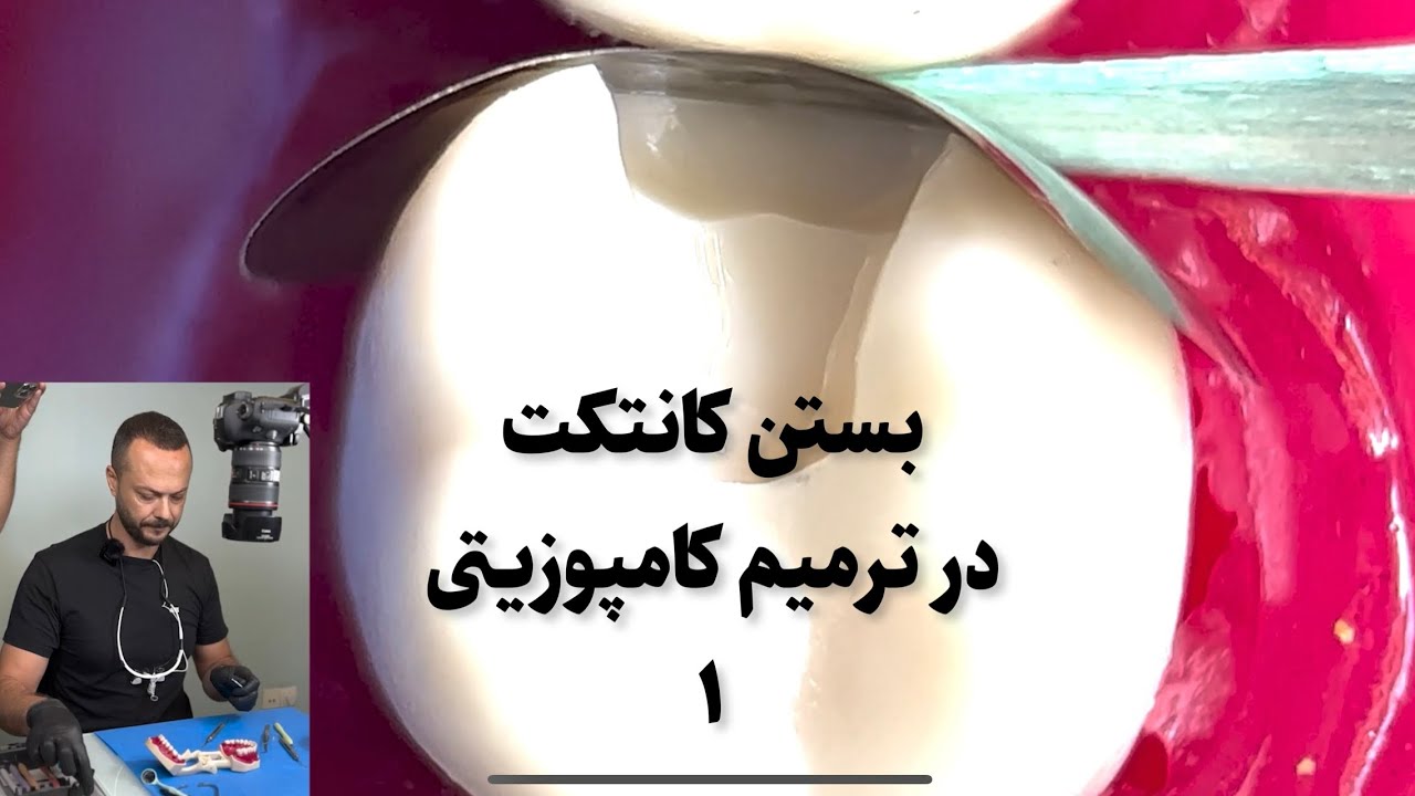 بستن کانتکت در ترمیم کامپوزیتی | پارت ١ | دکتر حسین تقوی | آکادمی قاف