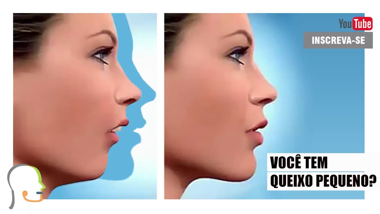 Você tem queixo pequeno? FAÇA SUA AVALIAÇÃO RÁPIDA (LINK NA DESCRIÇÃO)
