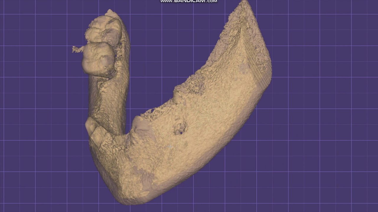 Генерируем 3D объект из КТ. ExoPlan ➜ ExoCad