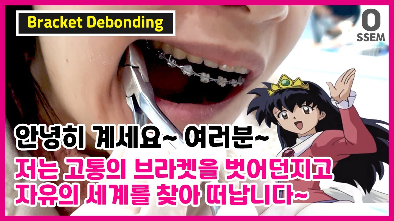 치아교정 끝나는날!! 장치(클리피씨 브라켓) 떼고 유지장치 부착!! (교정장치 제거과정, brace bracket debonding)